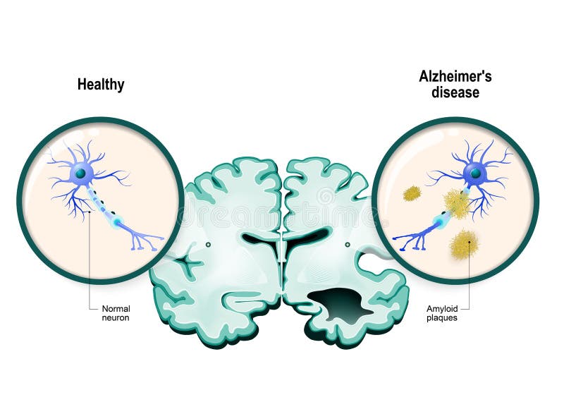 De ziekte van Alzheimer ` s Neuronen en hersenen
