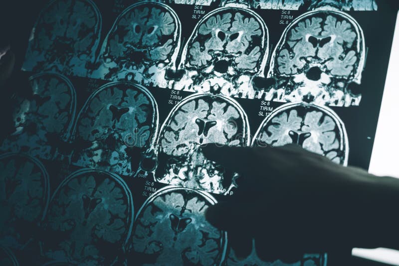 De ziekte van Alzheimer ` s op MRI stock afbeelding De ziekte van Alzheimer ` s op MRI stock afbeelding