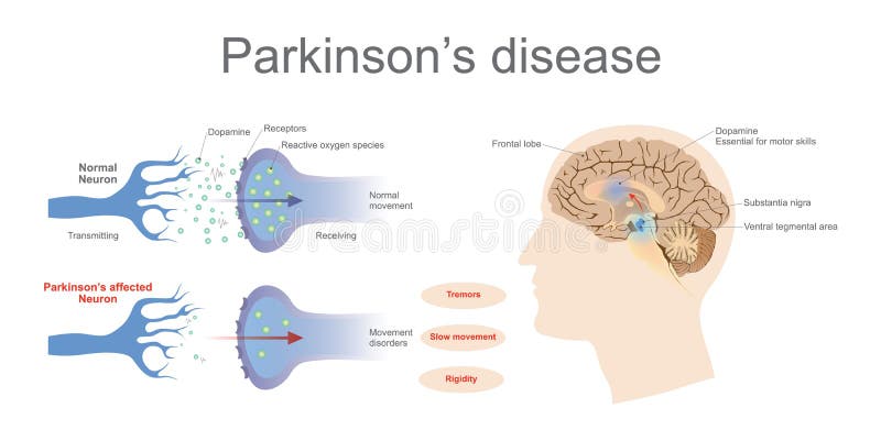 De ziekte van Parkinson ` s