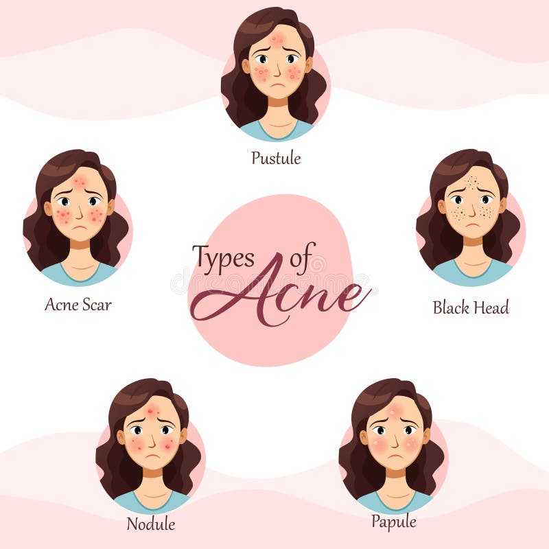 Decoding Acne a Comprehensive Guide To Different Types and Effective(05)