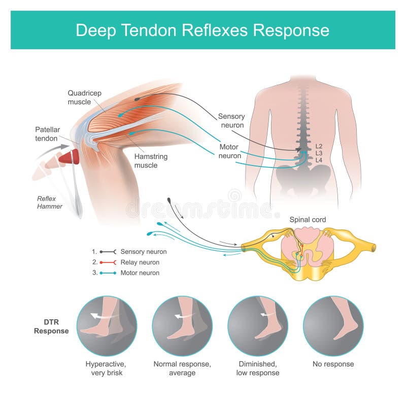 Evaluate Deep tendon Reflexes. Evaluate Deep tendon akhill Reflexes.