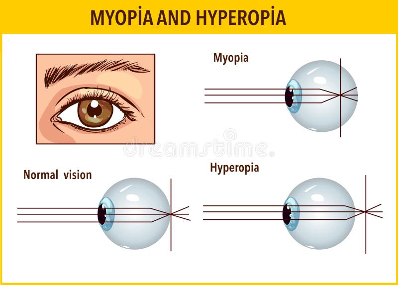 megszerzett myopia alakul ki kórtörténet szemészeti rövidlátásban