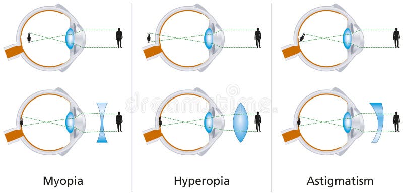 látáskezelés önhipnózissal a látás javítása érdekében, mi csöpög le