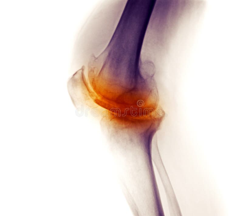 X-ray showing severe degenerative osteoarthritis in the knee of a 58 year old man. X-ray showing severe degenerative osteoarthritis in the knee of a 58 year old man