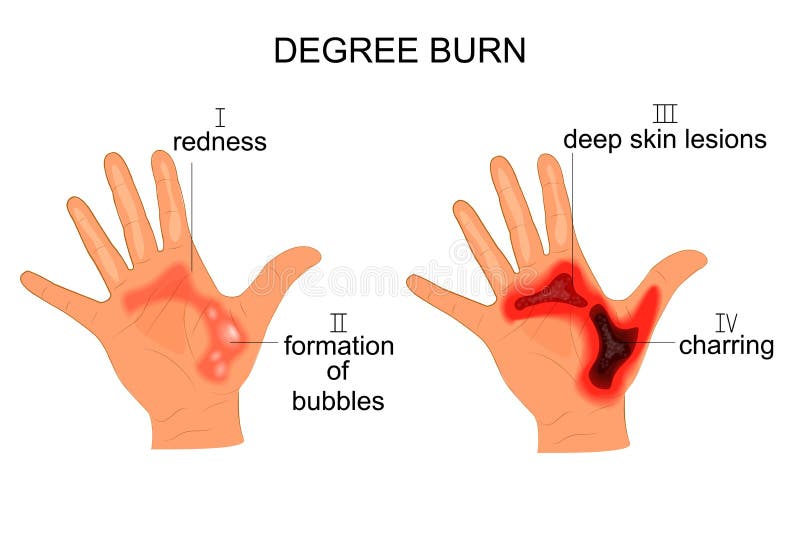Burn Injury Cartoon Stock Illustrations – 143 Burn Injury Cartoon Stock Illustrations, Vectors & Clipart - Dreamstime Burn Injury Cartoon Stock Illustrations – 143 Burn Injury Cartoon Stock Illustrations, Vectors & Clipart - Dreamstime
