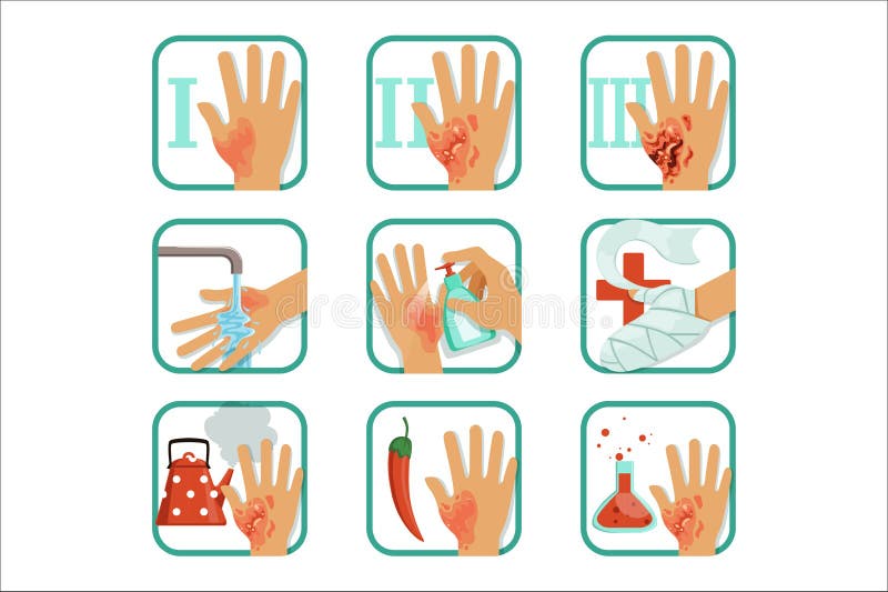 Degree burns set, burns treatment and classification vector Illustrations royalty free illustration