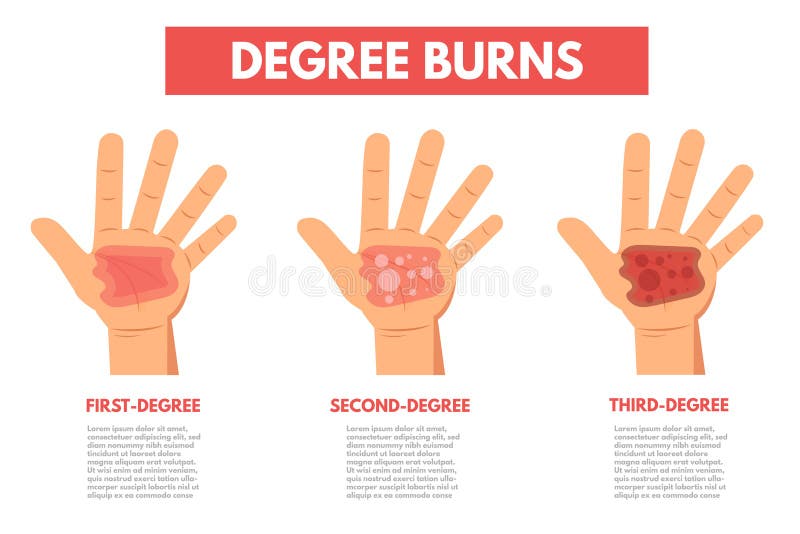 Degree burns of skin. Infographic vector illustration Degree burns of skin. Infographic vector illustration