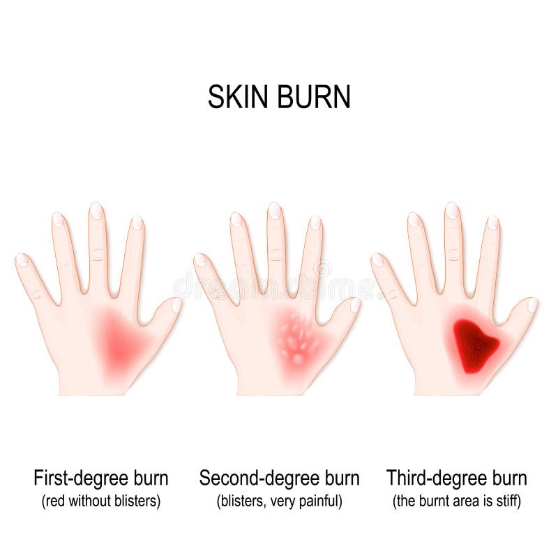 Degree burns of skin. step of burn royalty free illustration Degree burns of skin. step of burn royalty free illustration