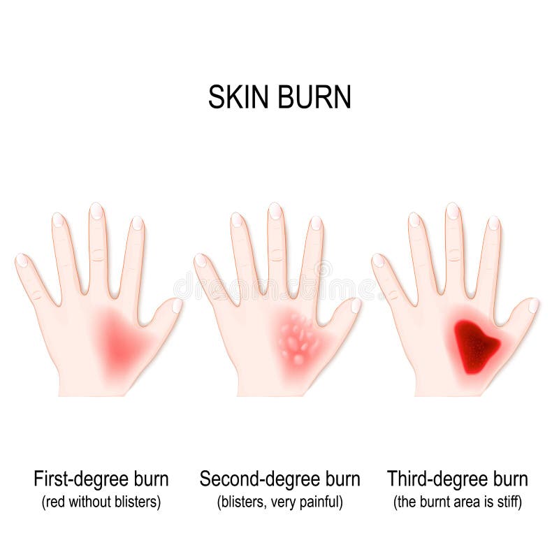 first degree burn hand