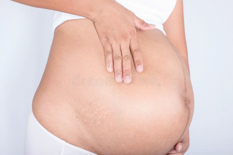Dehnungsstreifen auf schwangeren Frauen stockbild Dehnungsstreifen auf schwangeren Frauen stockbild