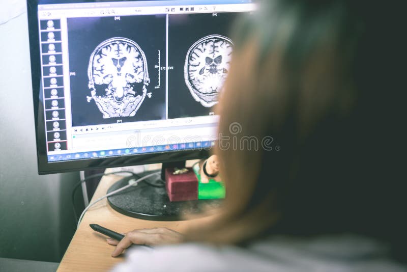 Demencja na MRI filmu móżdżkowa demencja