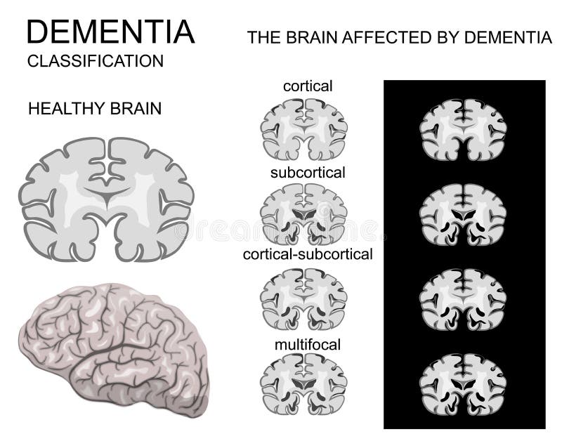 Dementia, Alzheimer's disease