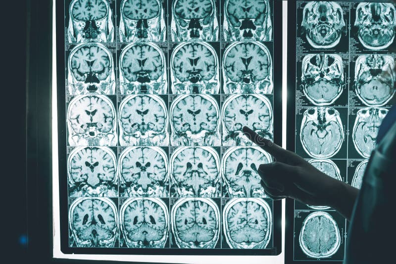 Dementia brain on MRI stock image. Image of science, neurology - 99184799