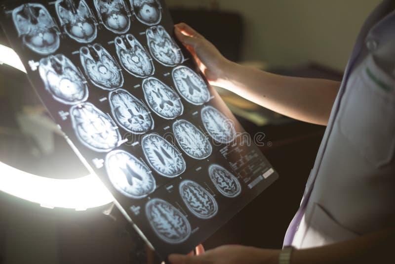 Brain MRI and dementia stock photo. Image of medical - 105374452