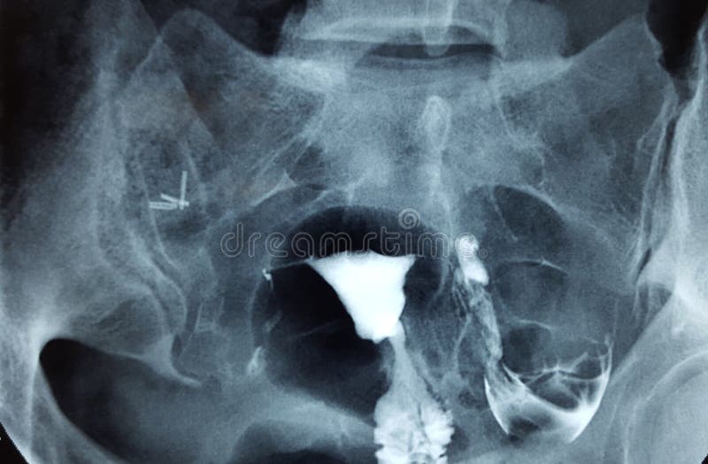 hysterosalpingography, show fallopian tube obstruction. Hysterosalpingography (HSG) is a radiologic procedure to investigate the shape of the uterine cavity and the shape and patency of the fallopian tubes. It entails the injection of a radio-opaque material into the cervical canal and usually fluoroscopy with image intensification. A normal result shows the filling of the uterine cavity and the b. hysterosalpingography, show fallopian tube obstruction. Hysterosalpingography (HSG) is a radiologic procedure to investigate the shape of the uterine cavity and the shape and patency of the fallopian tubes. It entails the injection of a radio-opaque material into the cervical canal and usually fluoroscopy with image intensification. A normal result shows the filling of the uterine cavity and the b