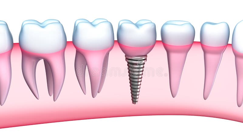 Den specificerade tand- implantatet beskådar. illustration 3D stock illustrationer Den specificerade tand- implantatet beskådar. illustration 3D stock illustrationer