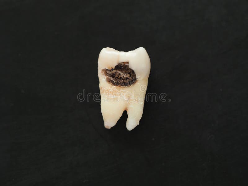 Dent simple de plan rapproché mauvaise avec le grand trou de carie sur le fond noir Dents malsaines photos libres de droits Dent simple de plan rapproché mauvaise avec le grand trou de carie sur le fond noir Dents malsaines photos libres de droits