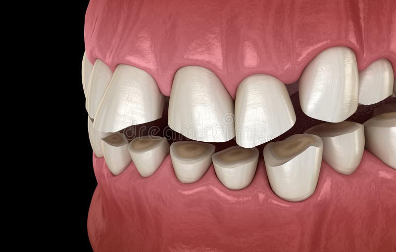 Dental attrition Bruxism resulting in loss of tooth tissue.  Medically accurate tooth illustration