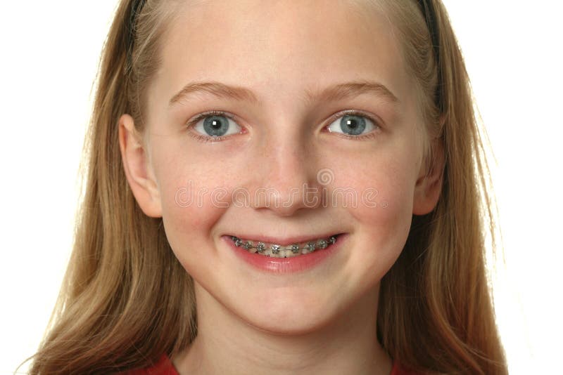 Little Girl Wearing Teeth Braces Stock Photo - Image of beautiful ...