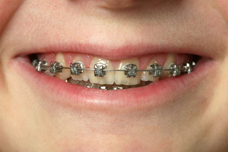 Dental Braces stock image. Image of teen, brace, caucasian 13268977