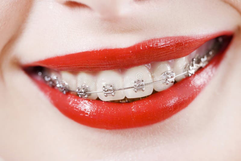 Dental braces