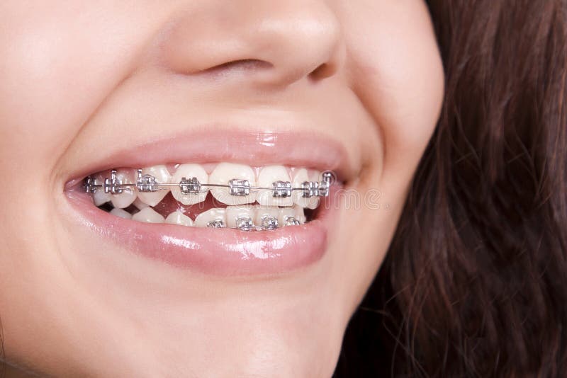 Teeth with braces stock image. Image of brackets, happy 20485419