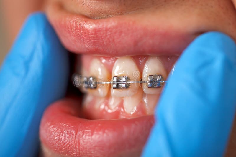 Dental braces stock image. Image of dentist, mouth, lips 35615961