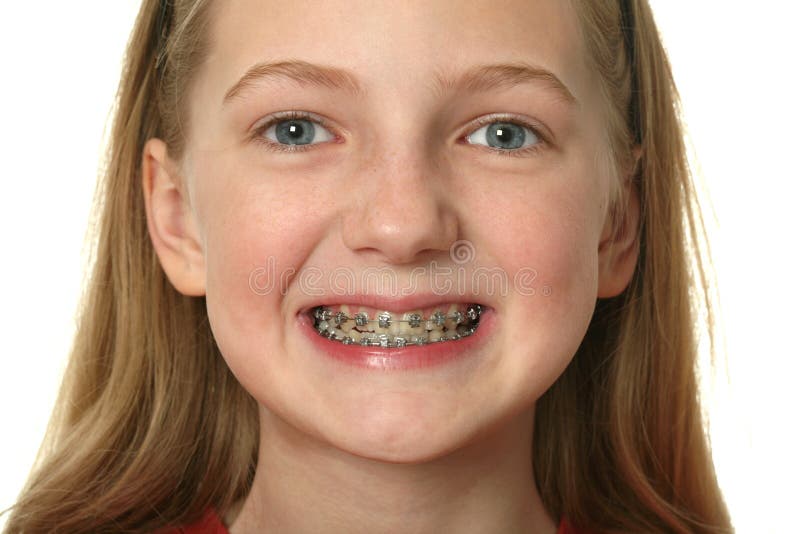 Dental Braces stock image. Image of healthcare, human - 13268983