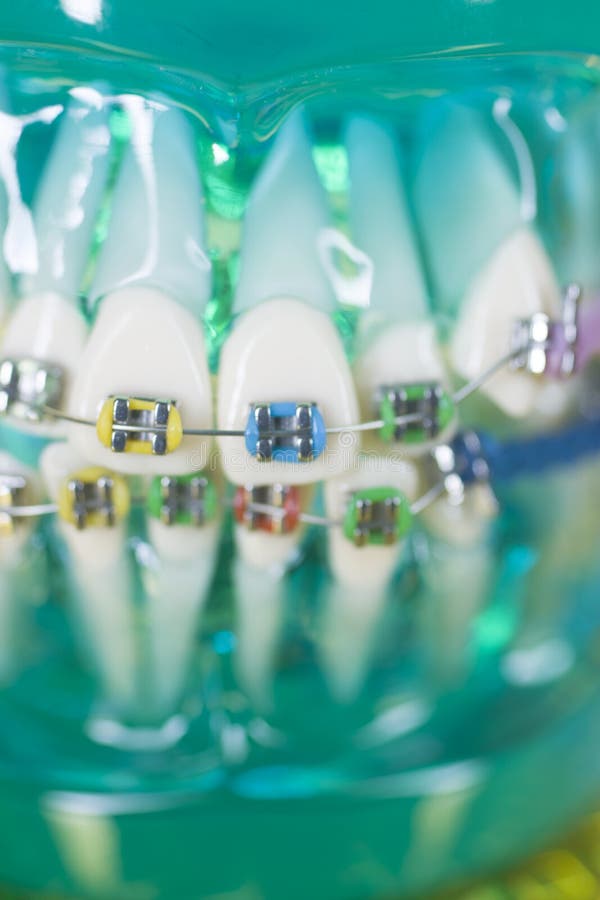 101 Orthodontic Invisible Braces Wire Photos Free & RoyaltyFree
