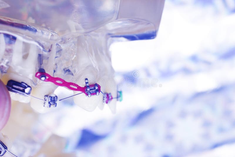 Dental Brackets Teeth Straighteners Stock Photo Image of aligning