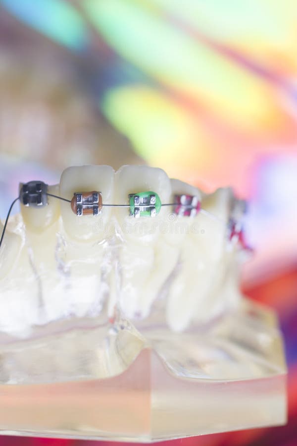 101 Orthodontic Invisible Braces Wire Photos Free & RoyaltyFree