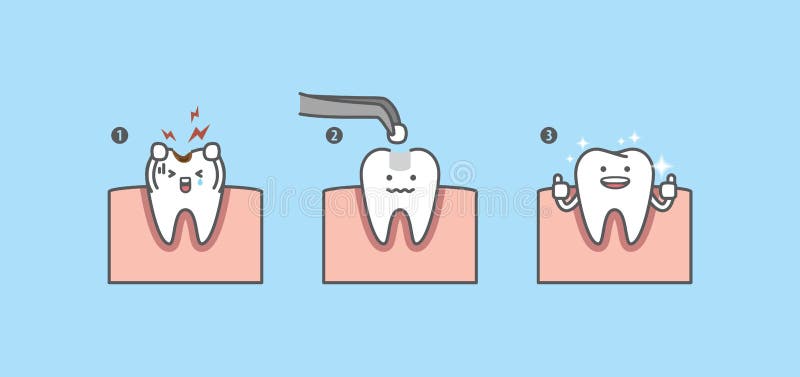 Dental Bridge Setting, Tooth Stomatology Vector Concept Illustration Stock  Vector - Illustration of crown, flat: 165521635
