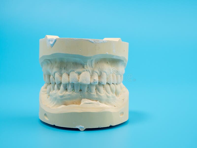 Dental Casts on a Blue Background. Plaster Model of Teeth Stock Image