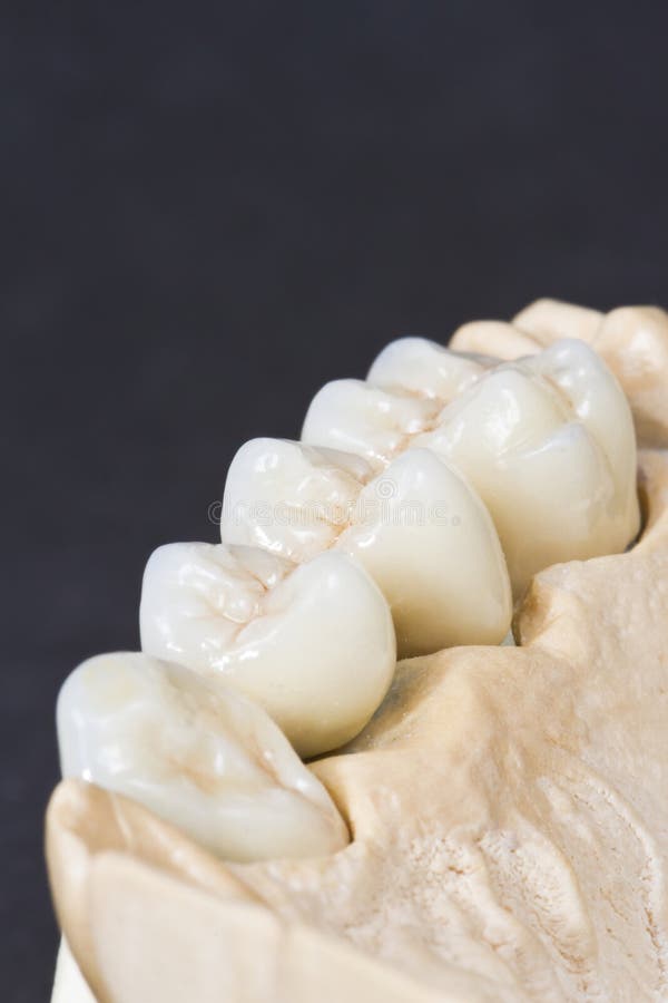 Porcelain Teeth Dental Bridge Stock Image Image of product, health