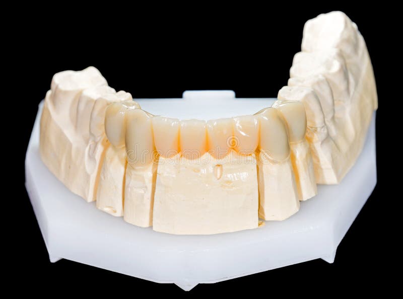 Dental ceramic bridge stock photo. Image of aesthetics 43999048