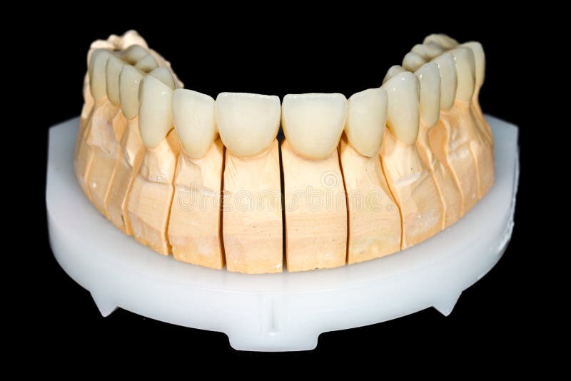 Dental ceramic bridge stock photo. Image of implants 86500642