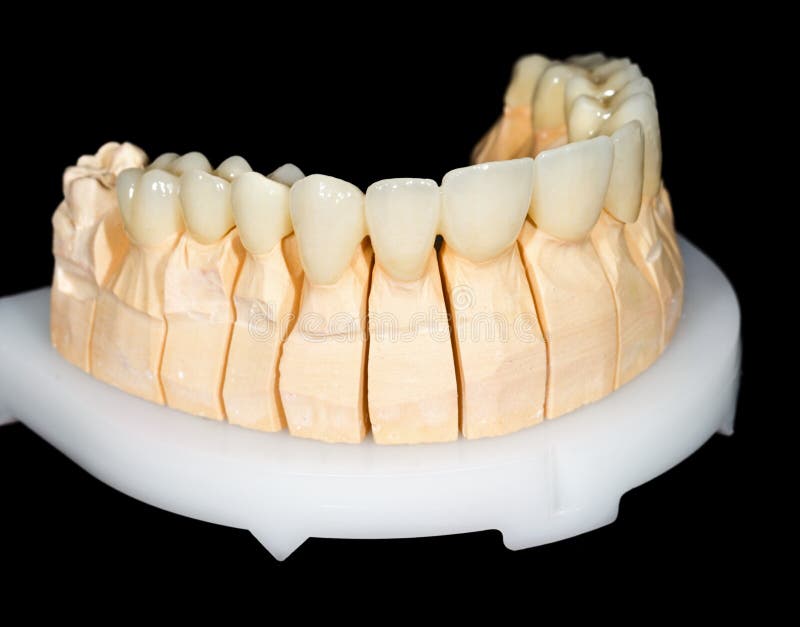 Dental ceramic crowns stock photo. Image of aesthetic 43999020