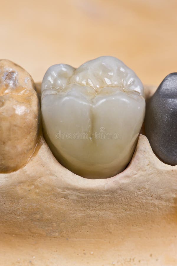 Dental ceramic crown stock photo. Image of closeup, tooth 29102314