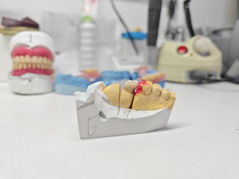 Dental Ceramic Crown on a Plaster Model in a Dental Laboratory Stock