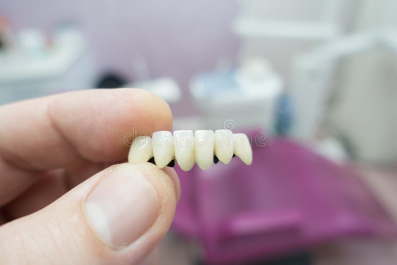 Dental Ceramic Metal Bridges in the Hands Stock Image Image of