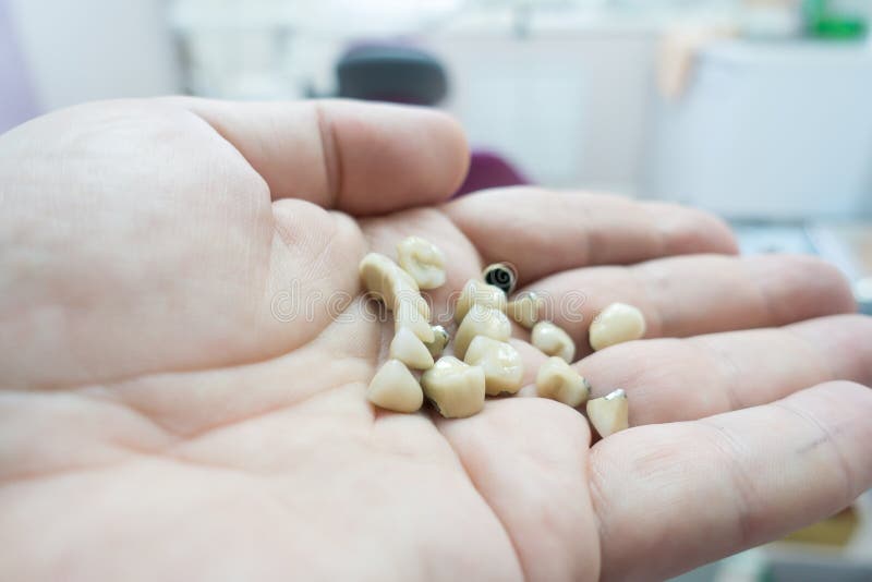 Dental Ceramic Metal Bridges Stock Photo Image of clinic, molar