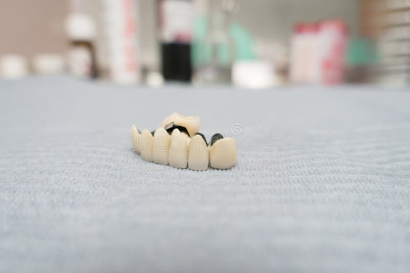 Dental Ceramic Metal Bridges Stock Image Image of clinic, bridge