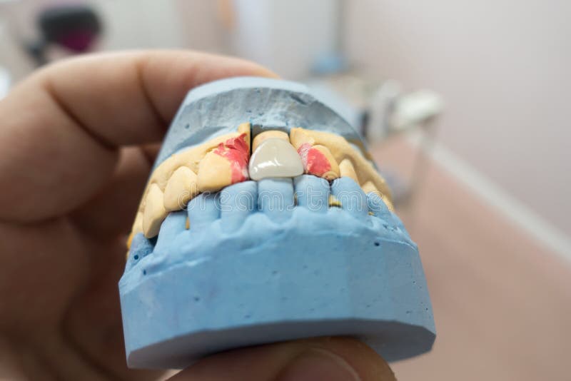 Plaster Model of Jaw in Hand Stock Photo Image of color, latex 21666142