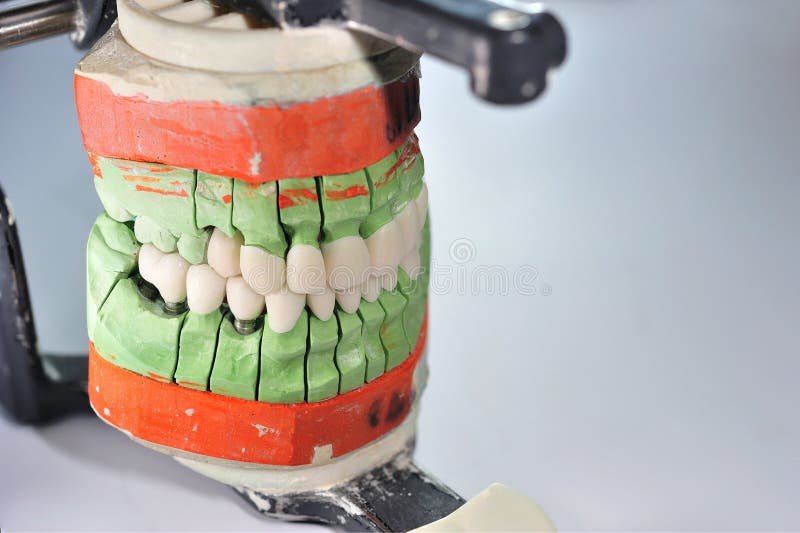 Dental Ceramic Prosthesis with Porcelain Teeth Stock Image Image of