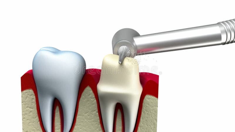 Root canal infection process. 3D Animati, Stock Video