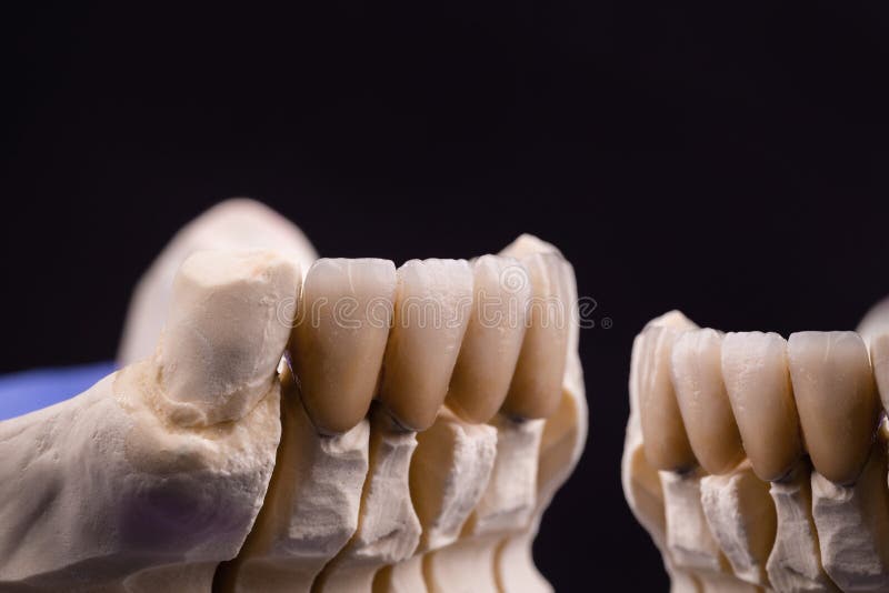 Dental Crowns. Closeup Ceramic Tooth Crown Stock Image Image of