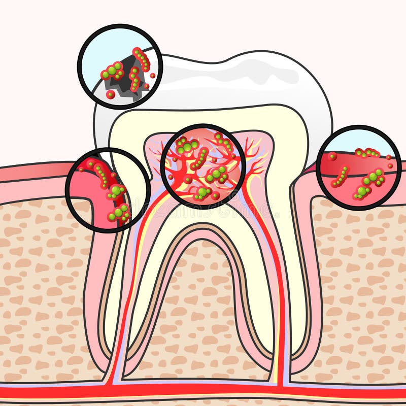 Dental diseases