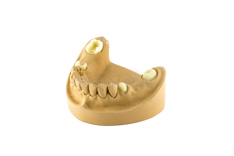 Dental cast stock photo. Image of closeup, crowns, molars 29835610
