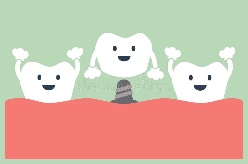 Dental implant with crown stock vector. Illustration of cute 72039481