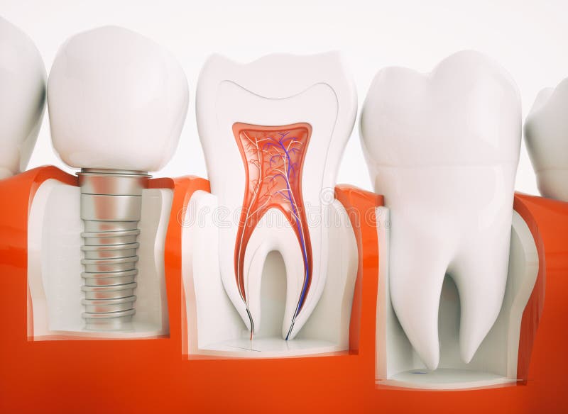 What Is the Need for Single-Tooth Dental Implants